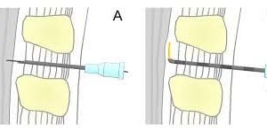 BD Yale Spinal - und Lumbalpunktionskanüle